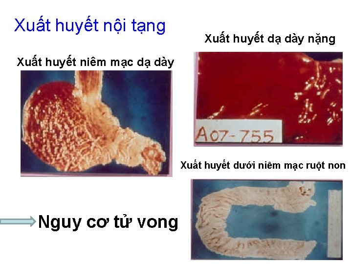 Xuất huyết nội tạng Xuất huyết dạ dày nặng Xuất huyết niêm mạc dạ Xuất huyết nội tạng Xuất huyết dạ dày nặng Xuất huyết niêm mạc dạ