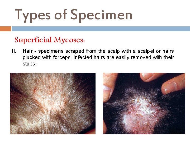 Types of Specimen Superficial Mycoses: II. Hair - specimens scraped from the scalp with