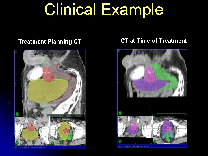 Clinical Example Treatment Planning CT CT at Time of Treatment 