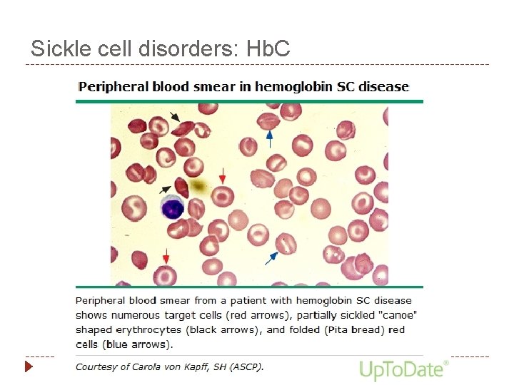 Sickle cell disorders: Hb. C 