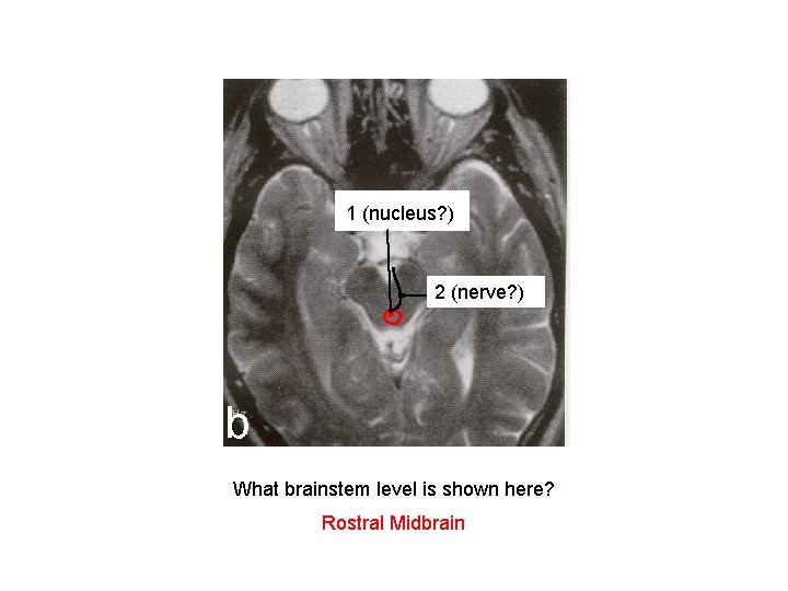 PAG, with Edinger 1 (nucleus? ) Westphal nucleus 2 III(nerve? ) nerve roots What