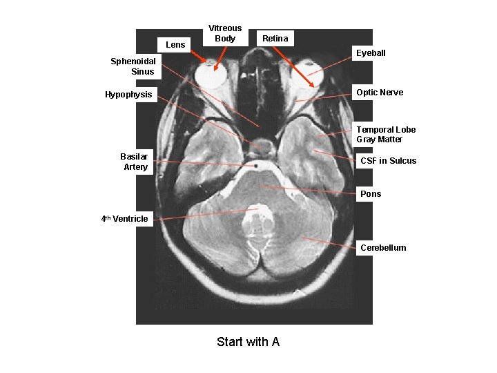 Lens. A Vitreous Body B Retina C Eyeball Sphenoidal Sinus Optic Nerve Hypophysis Temporal