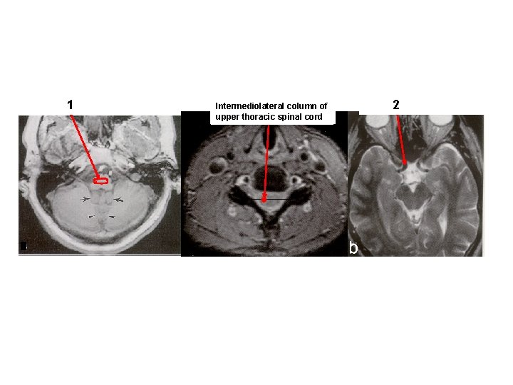 Reticular 1 formation General of descending If this is area Intermediolateral a cervical column