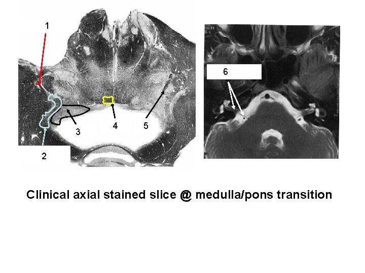 Vestibular Nerve 1 Roots Vestibulocochlear 6 nerve Vestibular 3 Nuclei MLF 4 Facial 5