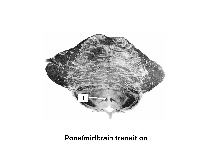 MLF 1 Pons/midbrain transition 