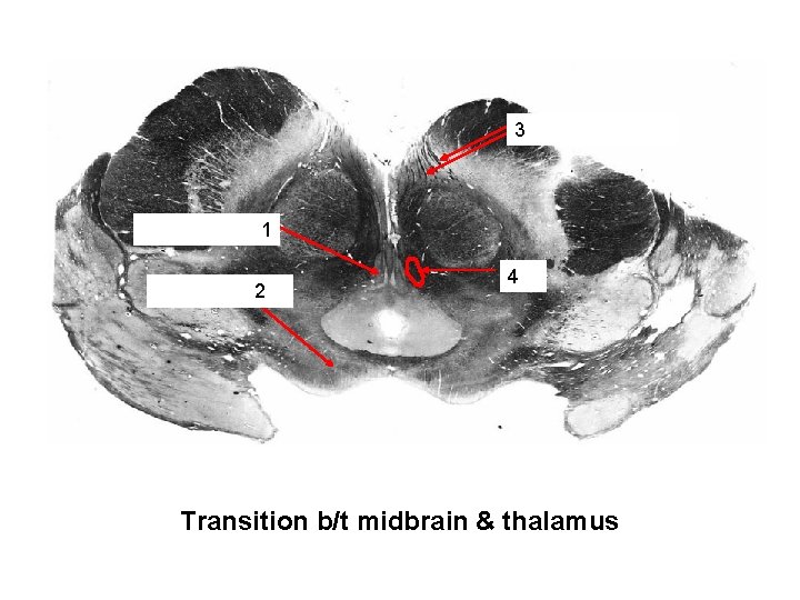 Oculomotor nerve roots 3 Oculomotor nucleus 1 Superior colliculus 2 MLF 4 Transition b/t