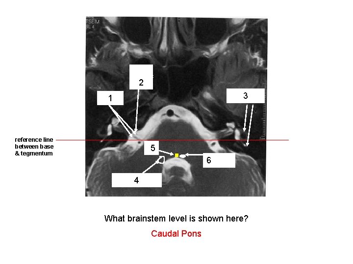 internal acoustic meatus 2 semicircular 3 canals VIII 1 nerve reference line between base