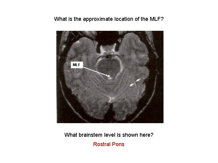 What is the approximate location of the MLF? MLF What brainstem level is shown