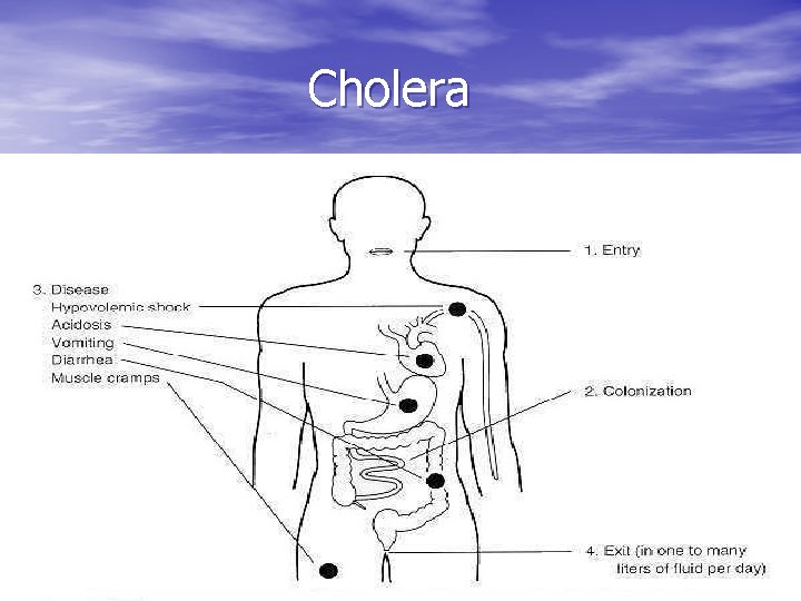 Cholera 