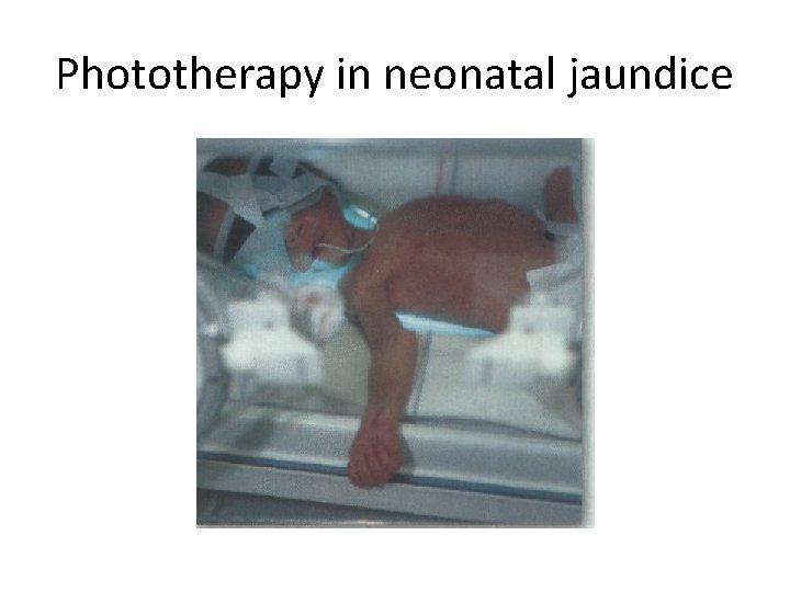 Phototherapy in neonatal jaundice 