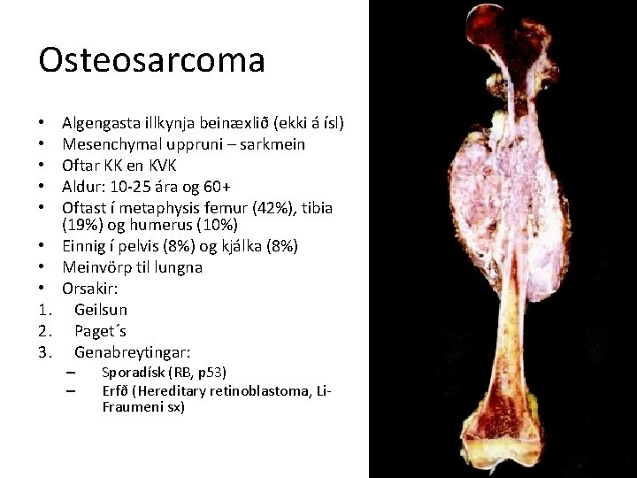 Osteosarcoma • • 1. 2. 3. Algengasta illkynja beinæxlið (ekki á ísl) Mesenchymal uppruni