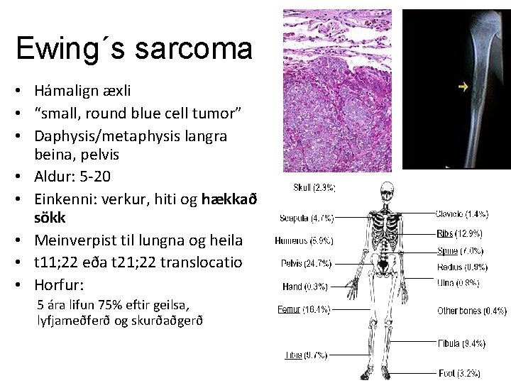 Ewing´s sarcoma • Hámalign æxli • “small, round blue cell tumor” • Daphysis/metaphysis langra