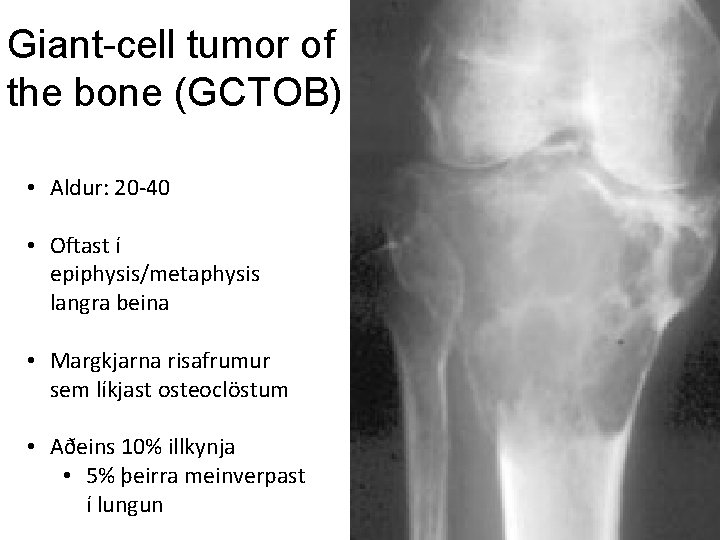 Giant-cell tumor of the bone (GCTOB) • Aldur: 20 -40 • Oftast í epiphysis/metaphysis