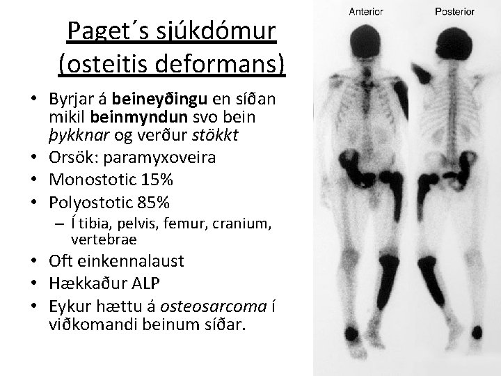 Paget´s sjúkdómur (osteitis deformans) • Byrjar á beineyðingu en síðan mikil beinmyndun svo bein