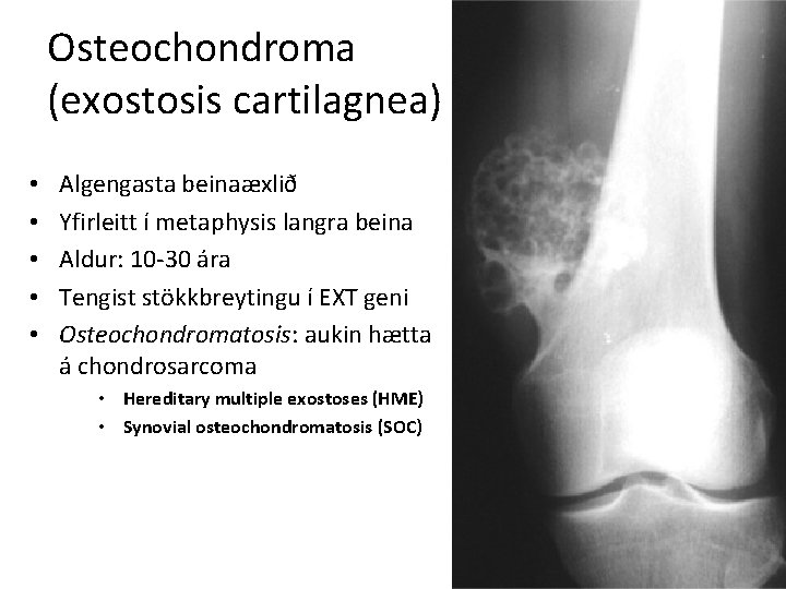 Osteochondroma (exostosis cartilagnea) • • • Algengasta beinaæxlið Yfirleitt í metaphysis langra beina Aldur: