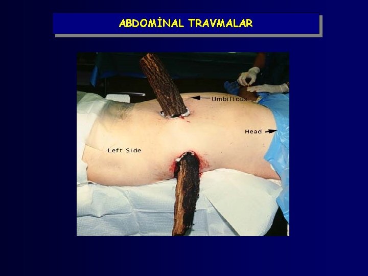 ABDOMİNAL TRAVMALAR 