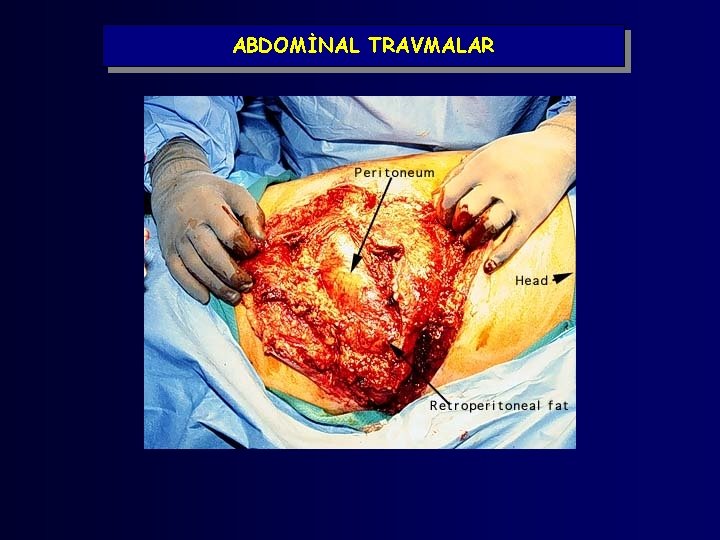 ABDOMİNAL TRAVMALAR 