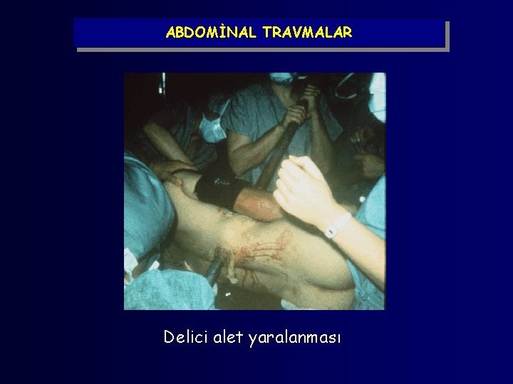 ABDOMİNAL TRAVMALAR Delici alet yaralanması 