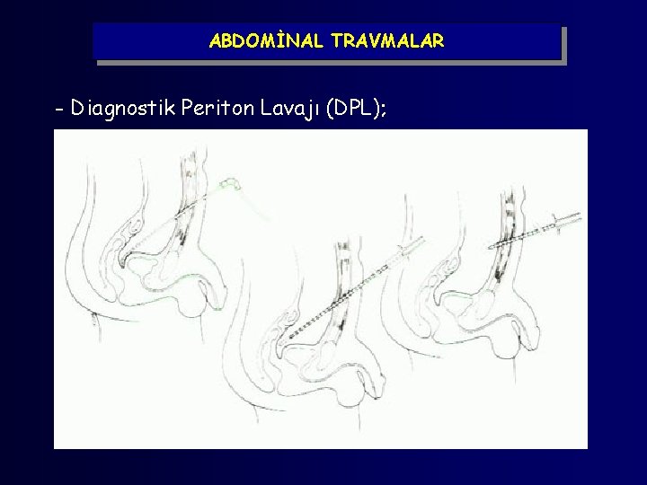 ABDOMİNAL TRAVMALAR - Diagnostik Periton Lavajı (DPL); 