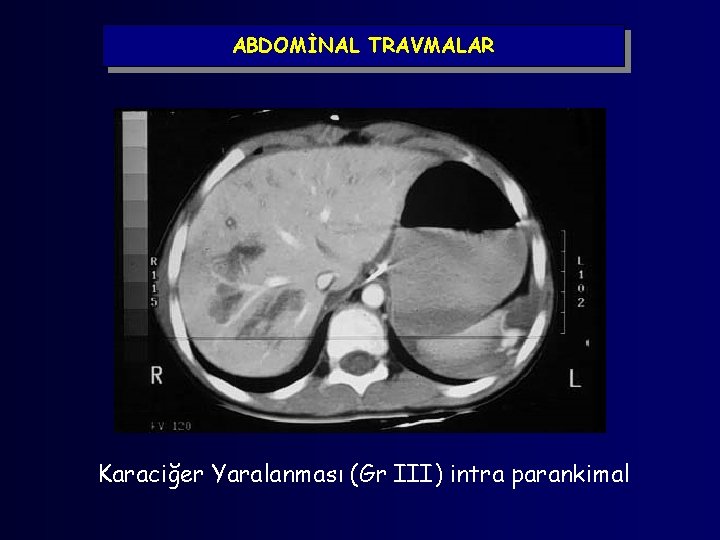 ABDOMİNAL TRAVMALAR Karaciğer Yaralanması (Gr III) intra parankimal 