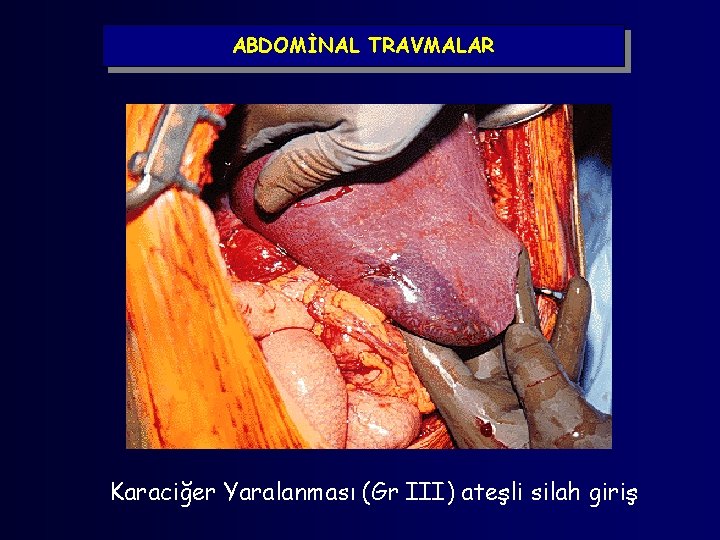 ABDOMİNAL TRAVMALAR Karaciğer Yaralanması (Gr III) ateşli silah giriş 