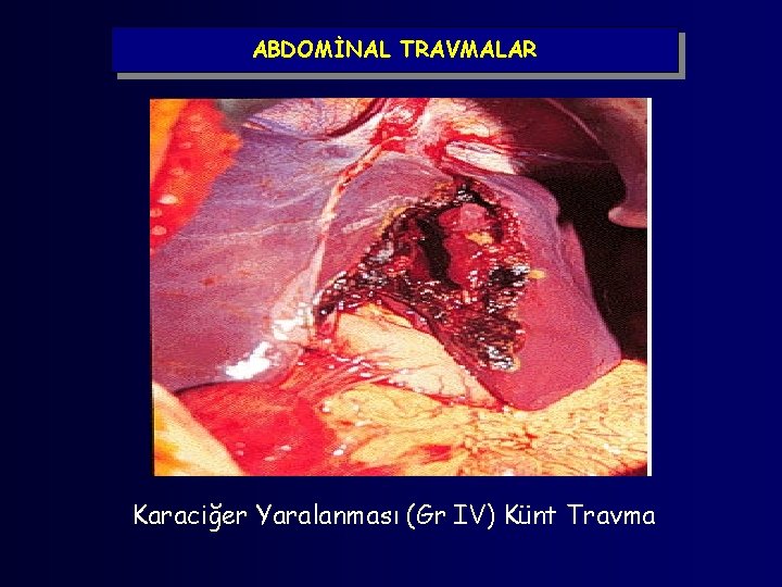 ABDOMİNAL TRAVMALAR Karaciğer Yaralanması (Gr IV) Künt Travma 