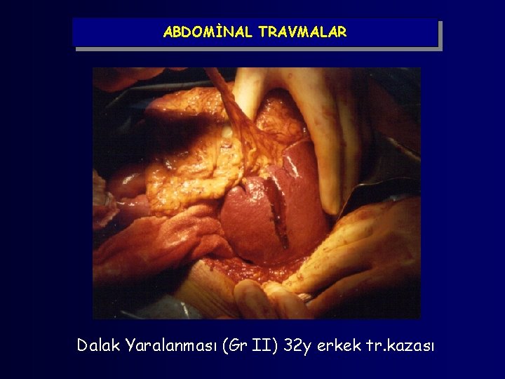 ABDOMİNAL TRAVMALAR Dalak Yaralanması (Gr II) 32 y erkek tr. kazası 