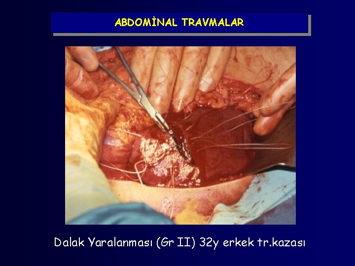 ABDOMİNAL TRAVMALAR Dalak Yaralanması (Gr II) 32 y erkek tr. kazası 