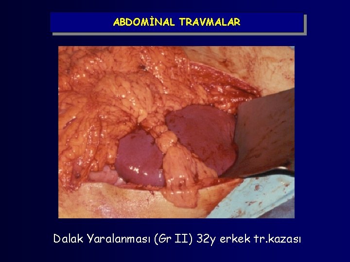 ABDOMİNAL TRAVMALAR Dalak Yaralanması (Gr II) 32 y erkek tr. kazası 