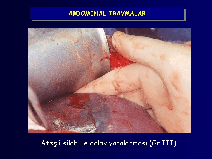 ABDOMİNAL TRAVMALAR Ateşli silah ile dalak yaralanması (Gr III) 