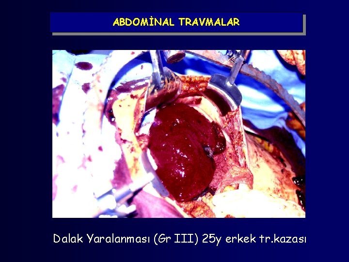 ABDOMİNAL TRAVMALAR Dalak Yaralanması (Gr III) 25 y erkek tr. kazası 