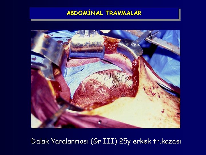 ABDOMİNAL TRAVMALAR Dalak Yaralanması (Gr III) 25 y erkek tr. kazası 