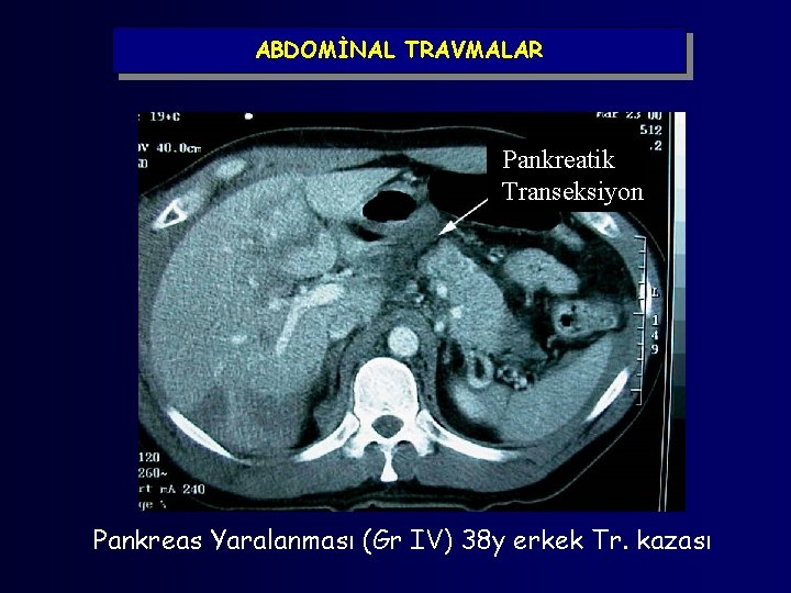 ABDOMİNAL TRAVMALAR Pankreatik Transeksiyon Pankreas Yaralanması (Gr IV) 38 y erkek Tr. kazası 