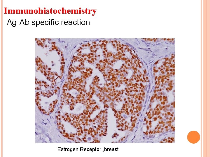 Immunohistochemistry Ag-Ab specific reaction Estrogen Receptor, , breast 