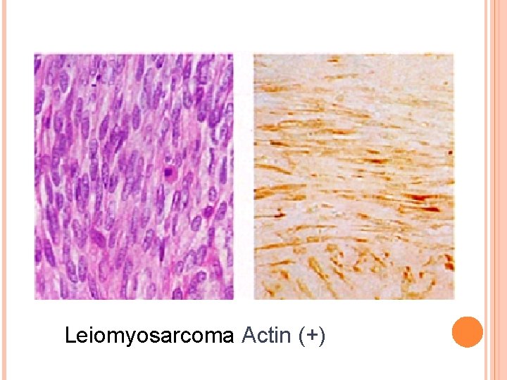 Leiomyosarcoma Actin (+) 