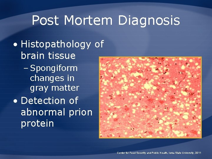 Post Mortem Diagnosis • Histopathology of brain tissue – Spongiform changes in gray matter