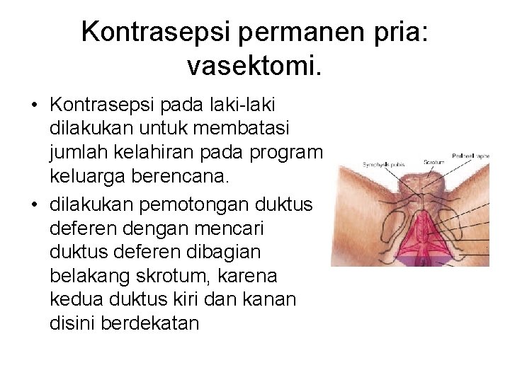 Kontrasepsi permanen pria: vasektomi. • Kontrasepsi pada laki-laki dilakukan untuk membatasi jumlah kelahiran pada