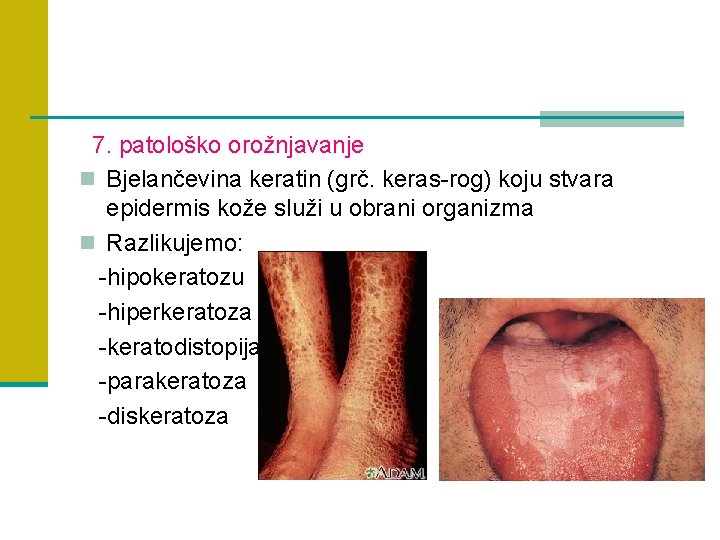7. patološko orožnjavanje n Bjelančevina keratin (grč. keras-rog) koju stvara epidermis kože služi u