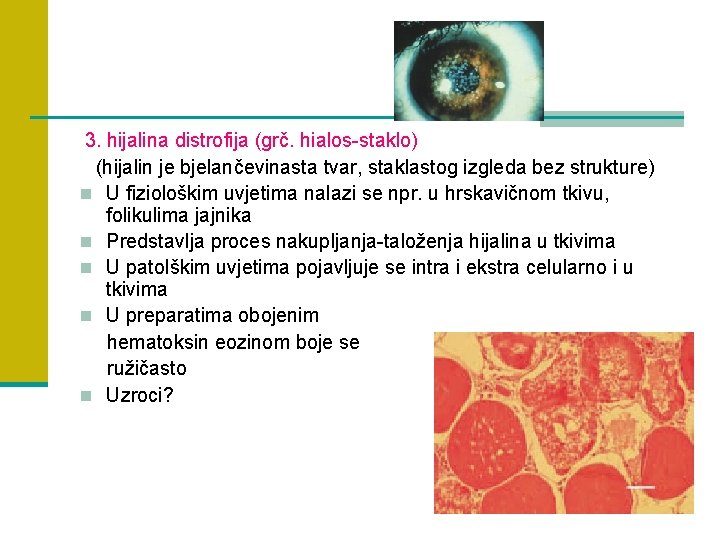 3. hijalina distrofija (grč. hialos-staklo) (hijalin je bjelančevinasta tvar, staklastog izgleda bez strukture) n