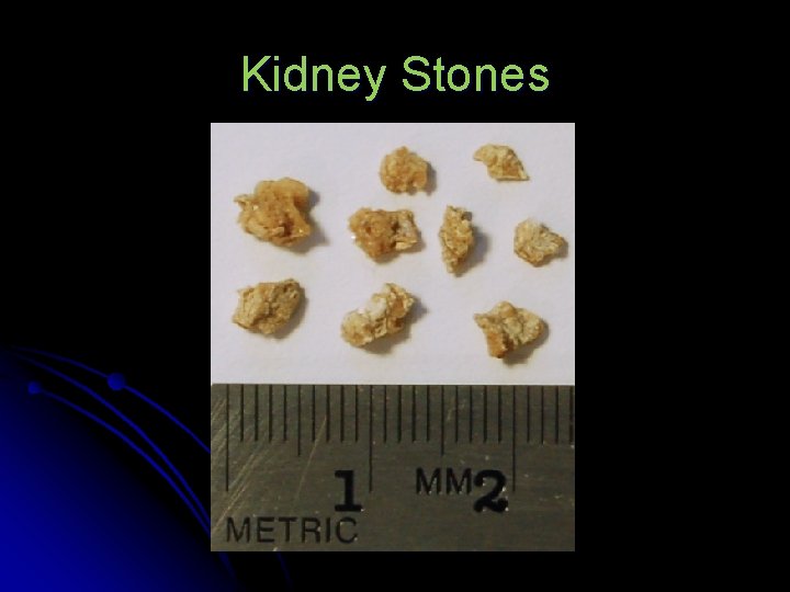 Kidney Stones 