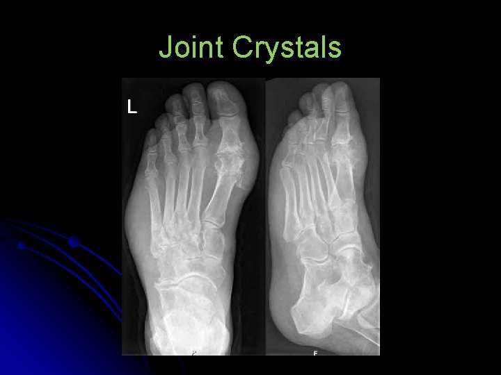 Joint Crystals 