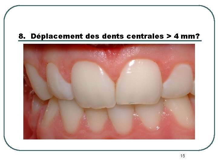 8. Déplacement des dents centrales > 4 mm? 15 