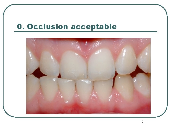 0. Occlusion acceptable 3 