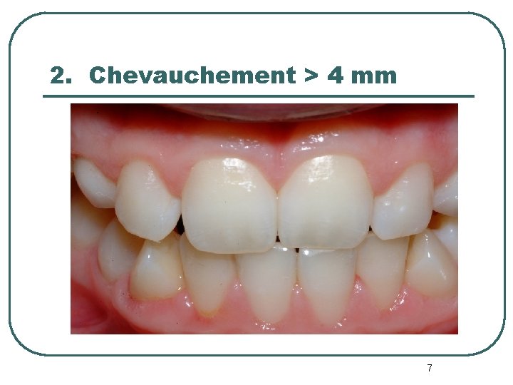 2. Chevauchement > 4 mm 7 