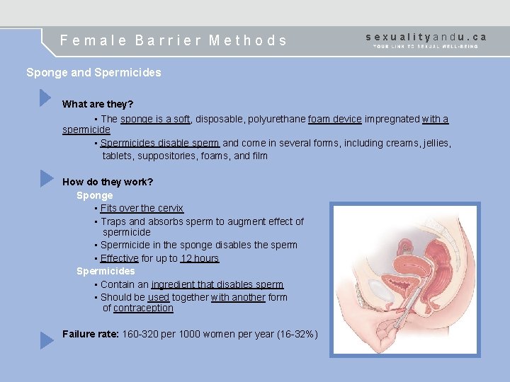 Female Barrier Methods sexualityandu. ca Sponge and Spermicides What are they? • The sponge