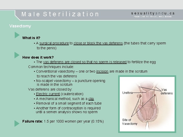 Male Sterilization sexualityandu. ca Vasectomy What is it? • A surgical procedure to close