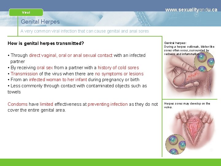 Viral www. sexualityandu. ca Genital Herpes A very common viral infection that can cause