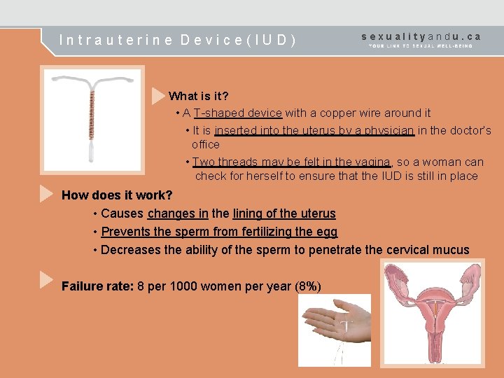 Intrauterine Device(IUD) sexualityandu. ca What is it? • A T-shaped device with a copper