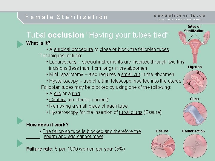 Female Sterilization sexualityandu. ca Tubal occlusion “Having your tubes tied” Sites of Sterilization What