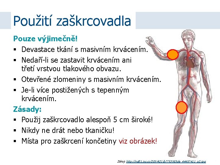 Použití zaškrcovadla Pouze výjimečně! Devastace tkání s masivním krvácením. Nedaří-li se zastavit krvácením ani